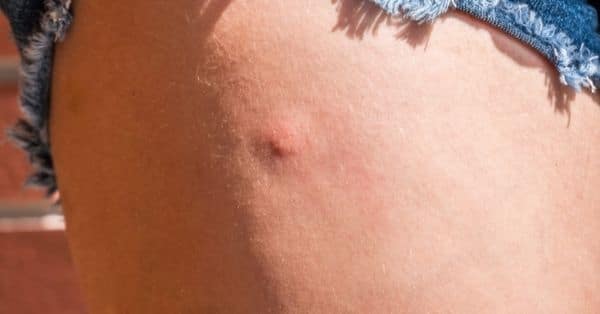 Picaduras de insectos